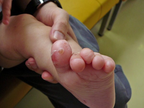 足指皮膚症状の写真