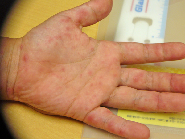手掌皮膚症状の写真
