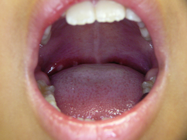 口腔内症状の写真