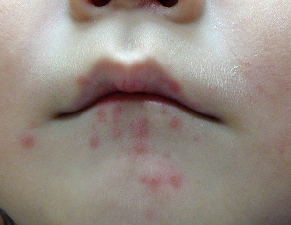 口唇の皮膚症状の写真