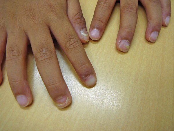 手指皮膚症状の写真
